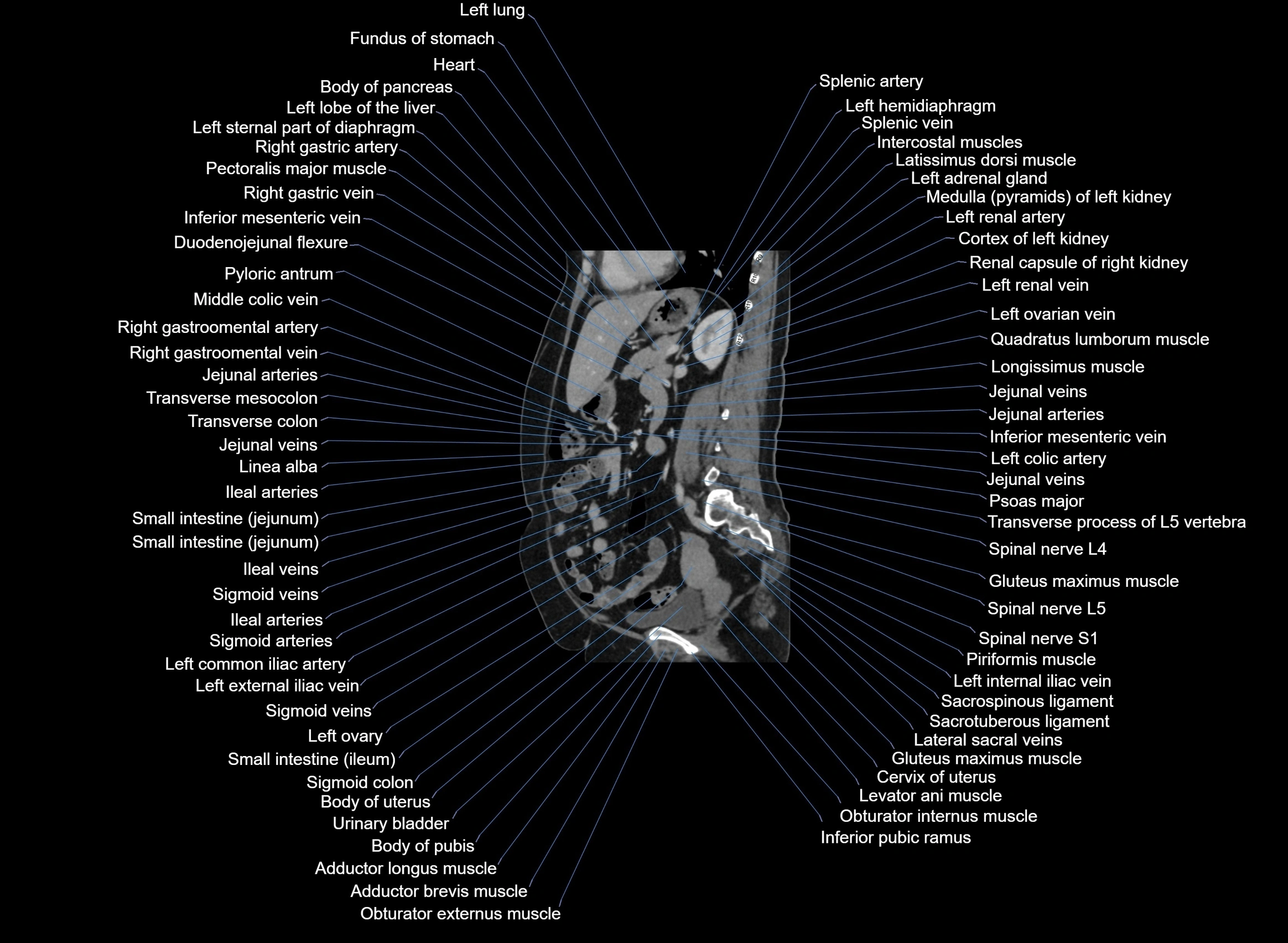 CT Abdomen sagittal cross sectional anatomy labelled radiology image -00049.webp